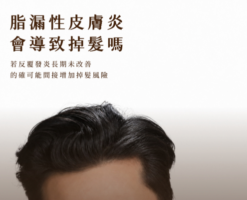 Scalp_seborrheic_dermatitis