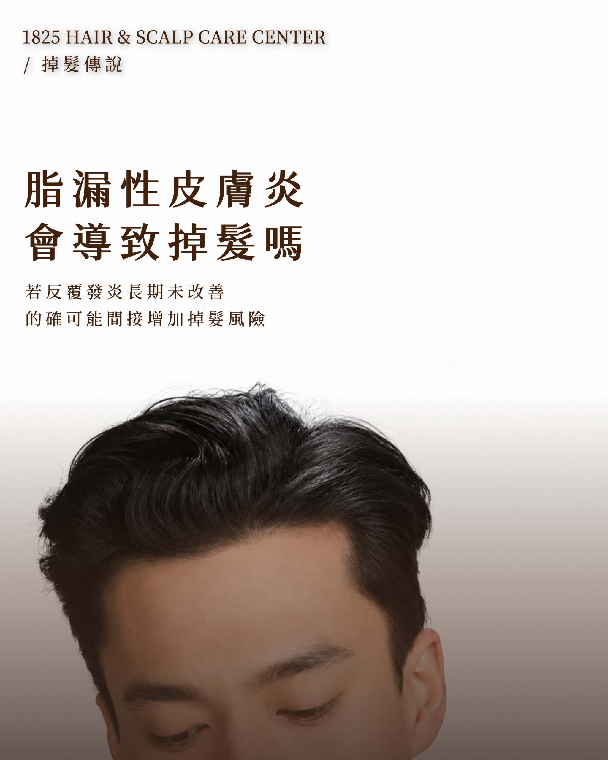 Scalp_seborrheic_dermatitis