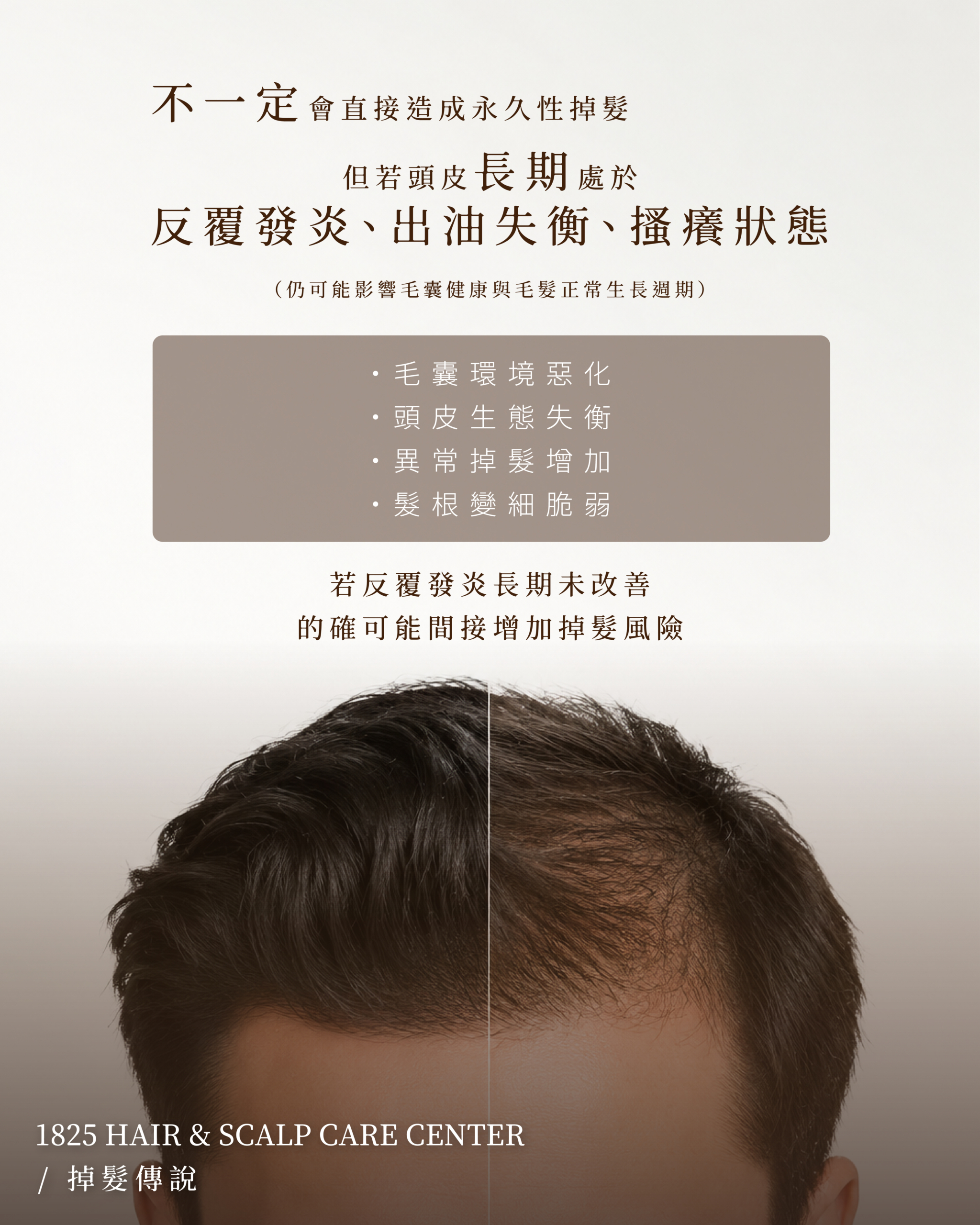  Scalp_seborrheic_dermatitis